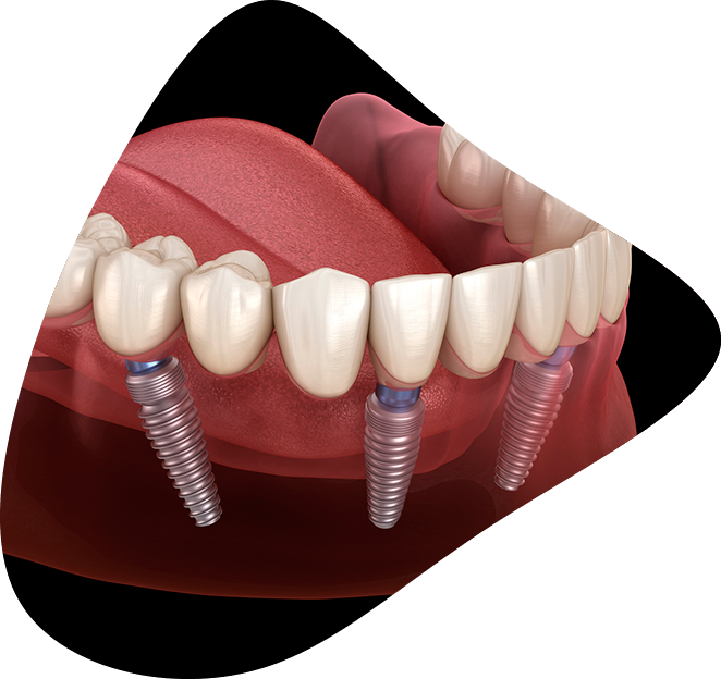 implantología oral en Torrelavega