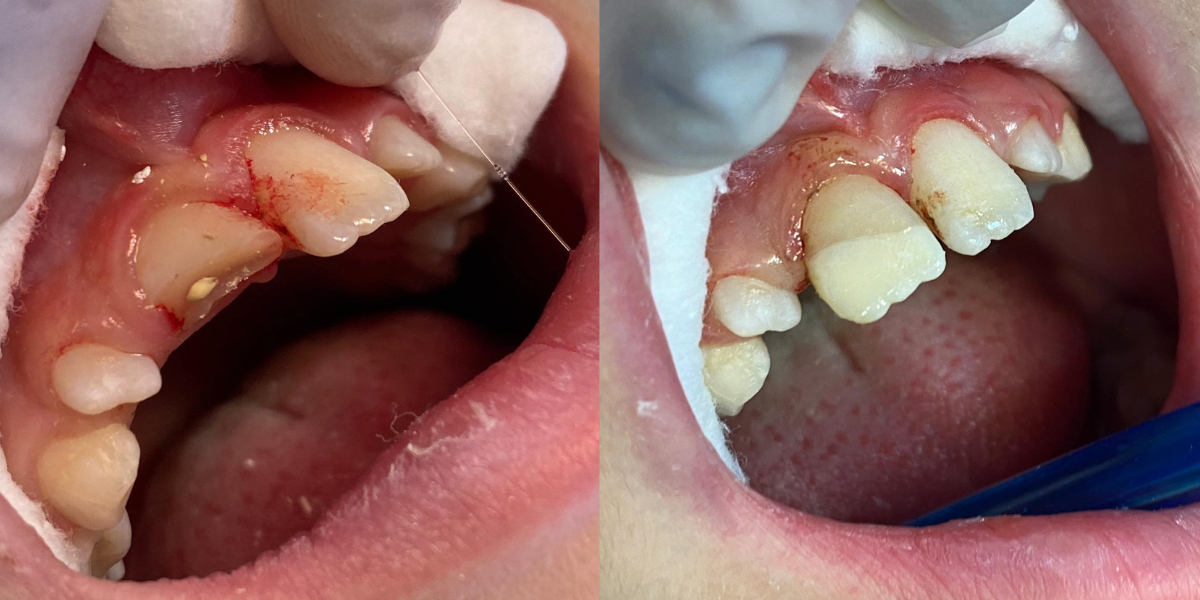 trauma o rotura dental