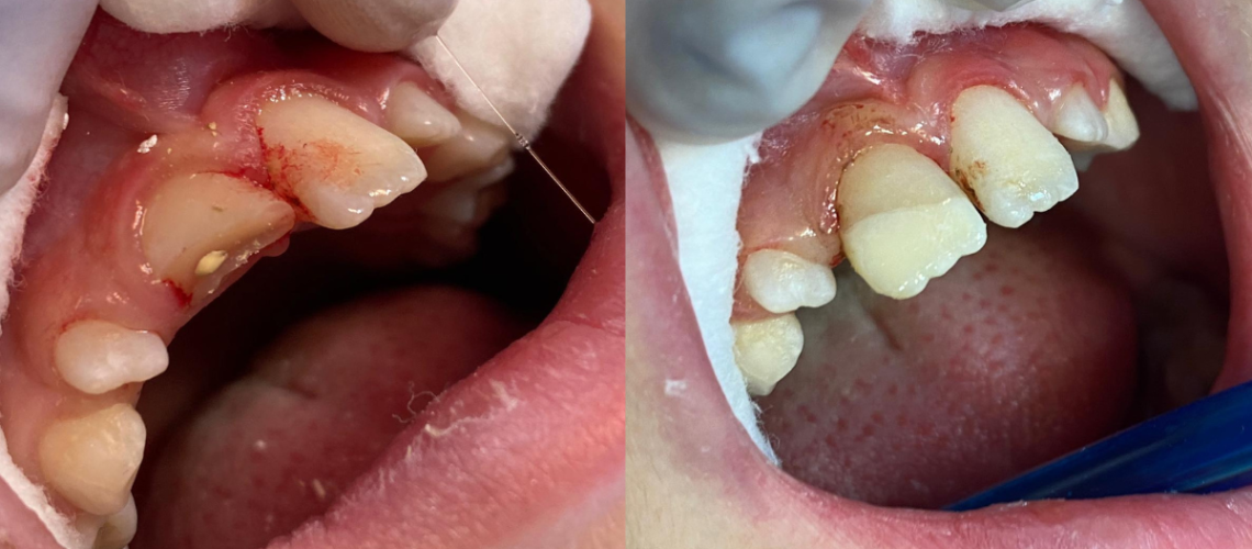 trauma o rotura dental